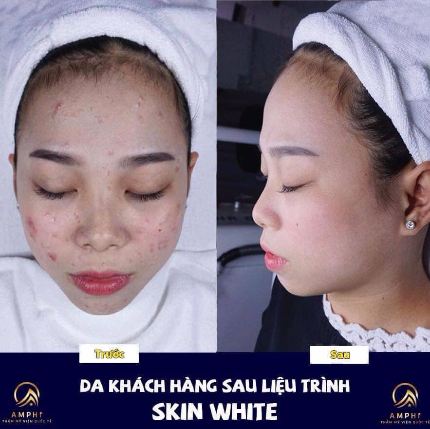 Điều trị mụn công nghệ Skin White tại Thẩm Mỹ Viện Amphi