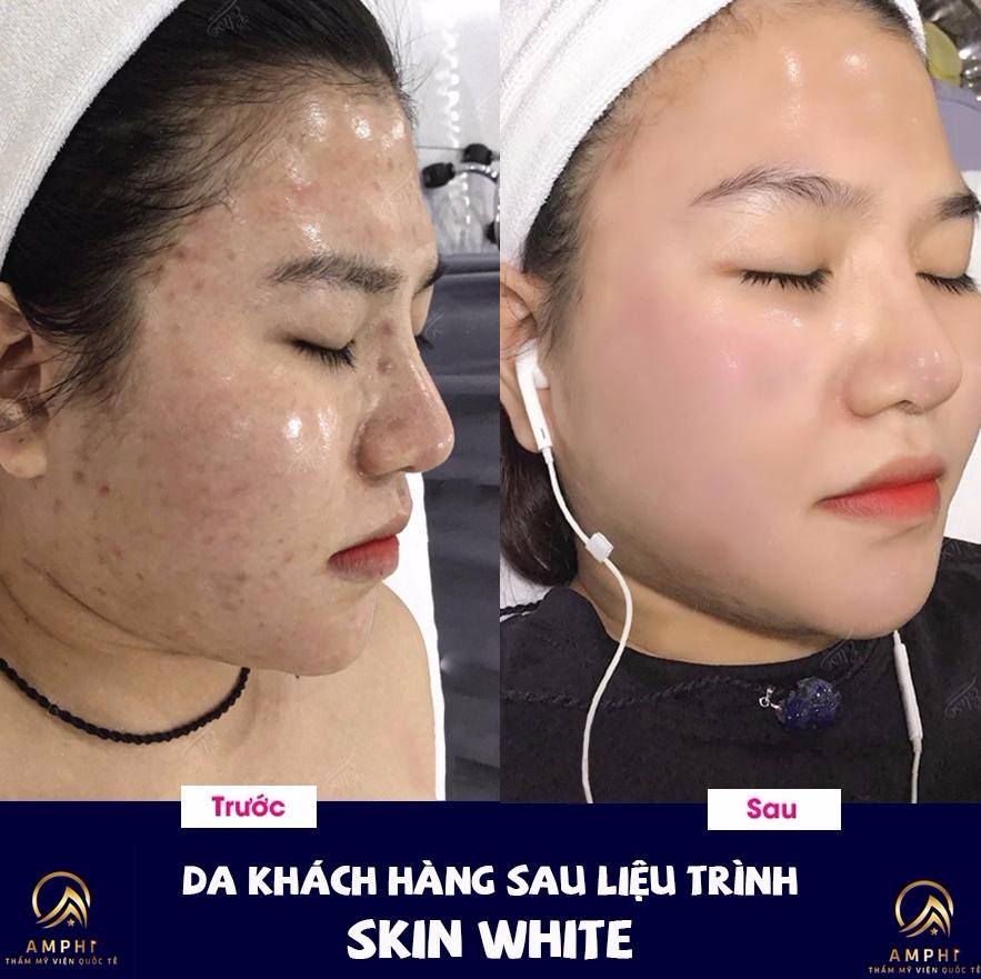 Điều trị mụn công nghệ Skin White tại Thẩm Mỹ Viện Amphi