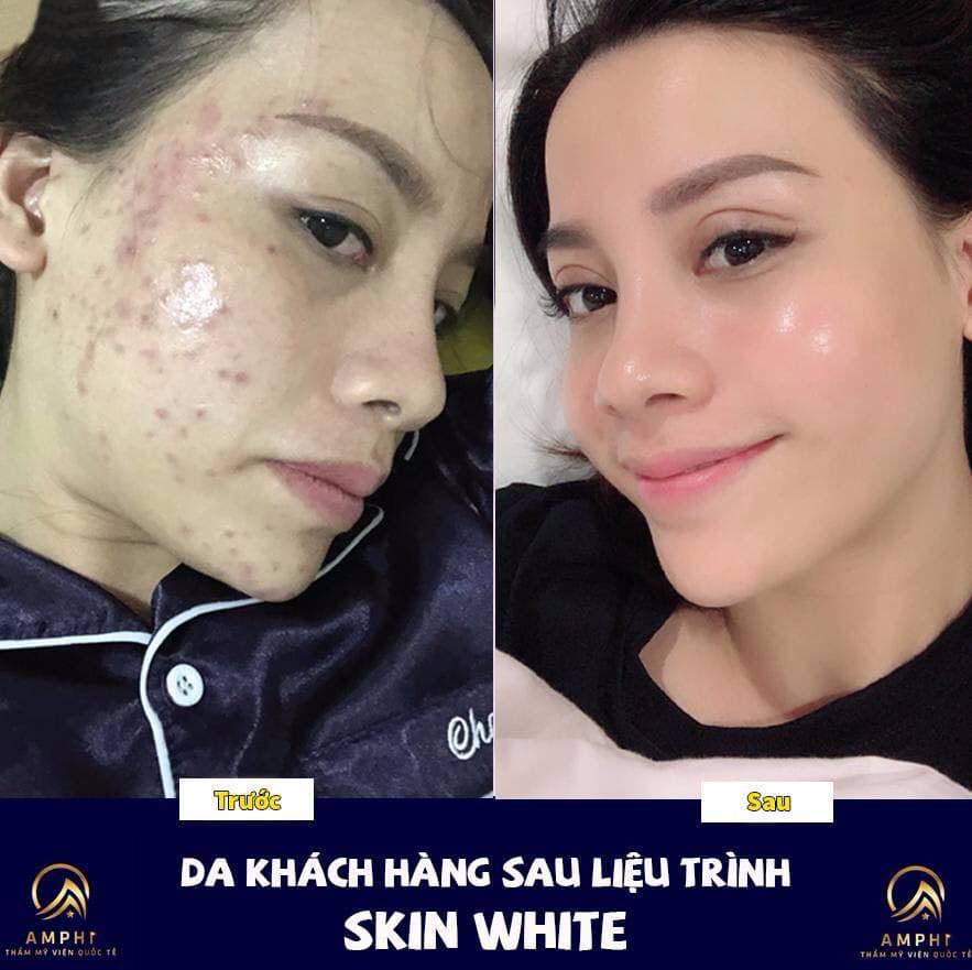 Điều trị mụn công nghệ Skin White tại Thẩm Mỹ Viện Amphi