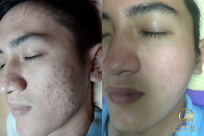 điều trị sẹo tại thẩm mỹ viện AmPhi