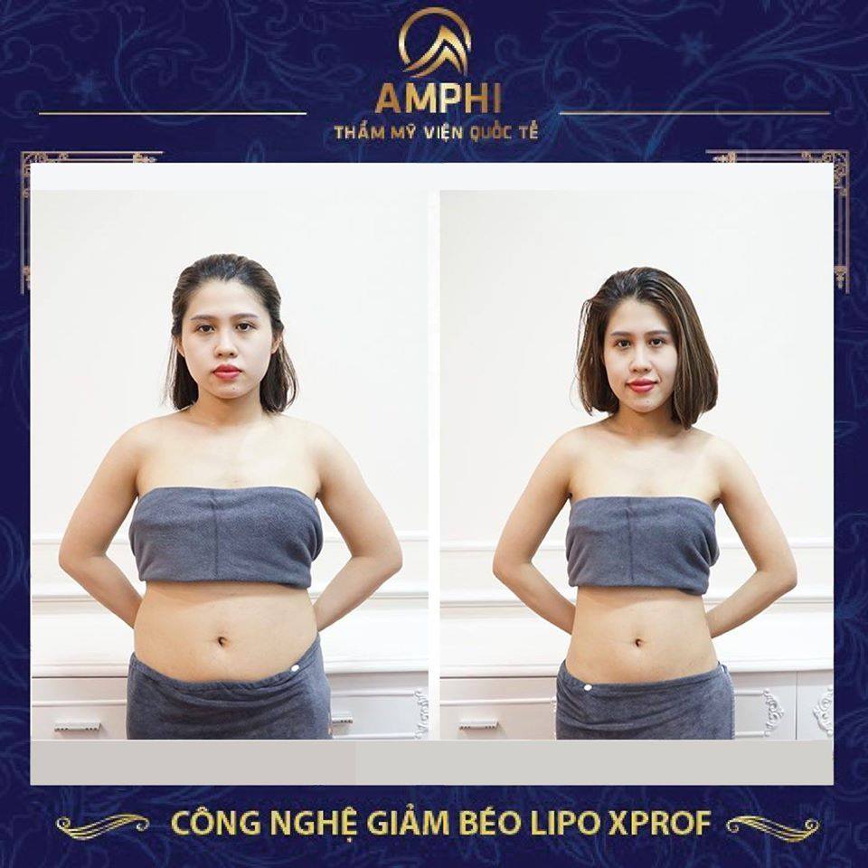 Giảm béo công nghệ Lifting Nature thẩm mỹ viện AmPhi Bắc Ninh