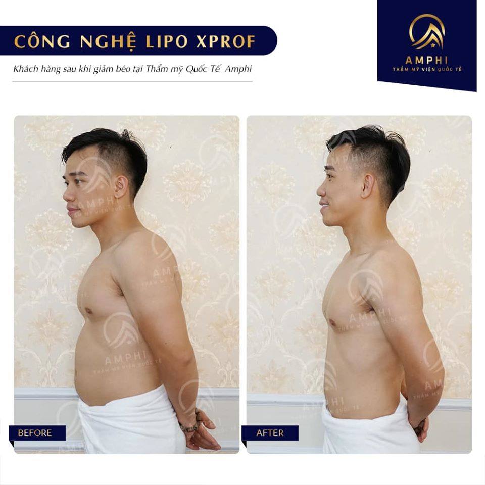 Giảm béo công nghệ Lifting Nature thẩm mỹ viện AmPhi Bắc Ninh