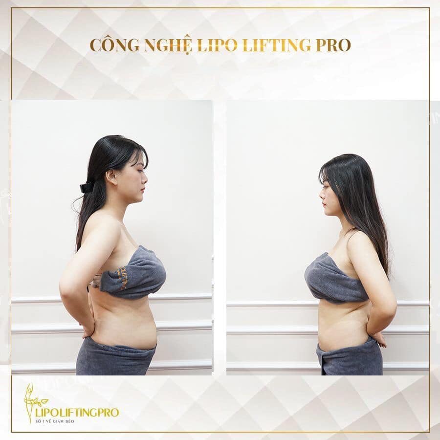 Giảm béo công nghệ Lifting Nature thẩm mỹ viện AmPhi Bắc Ninh