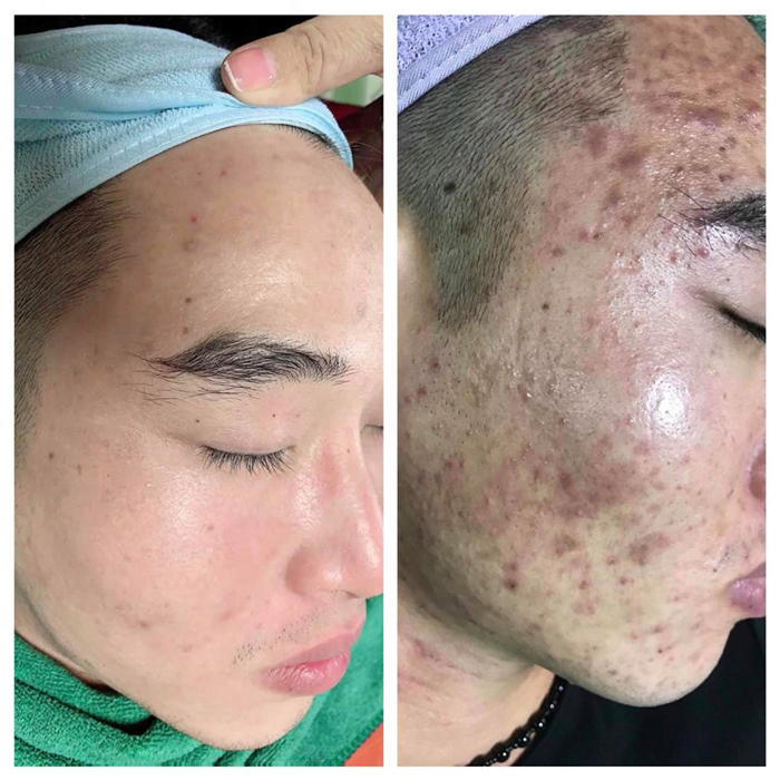 khách hàng điều trị mụn tại AmPhi