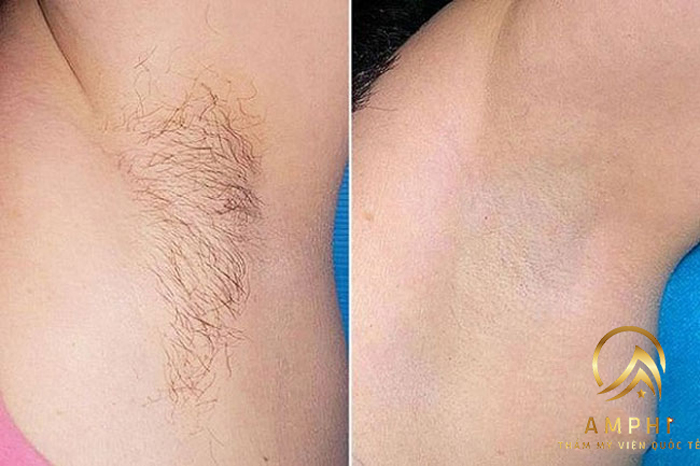 khách hàng triệt lông tại AmPhi