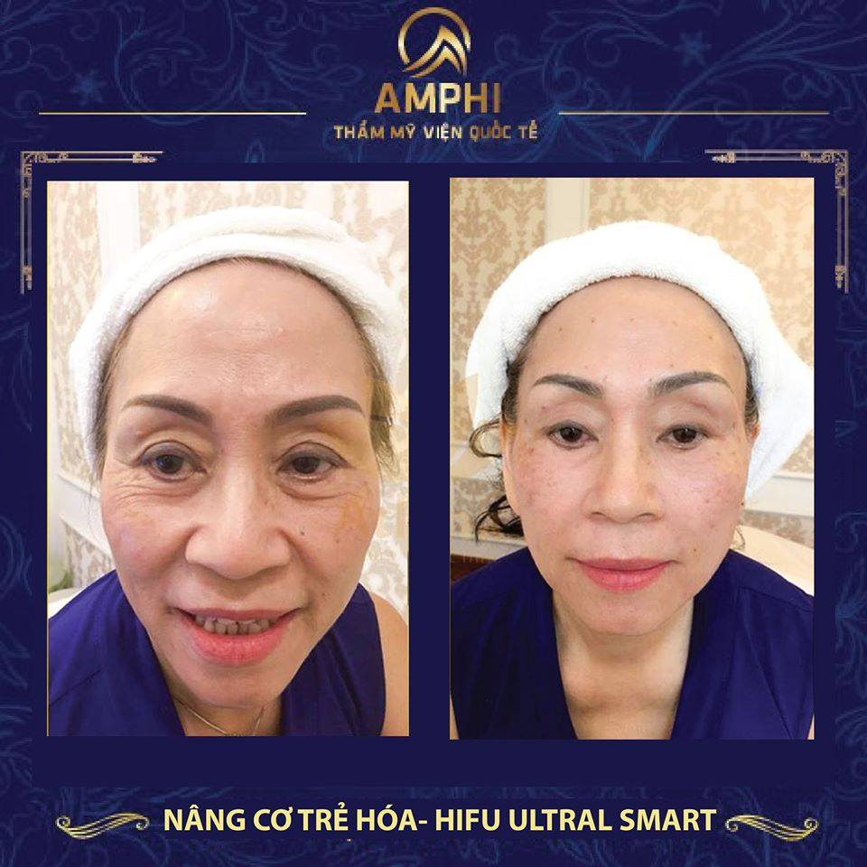 Nâng cơ trẻ hoá xoá nếp nhăn tại thẩm mỹ viện Amphi