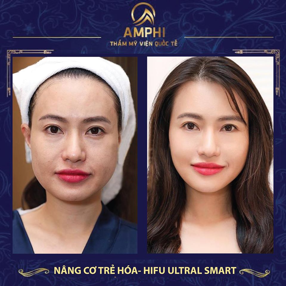 Nâng cơ trẻ hoá xoá nếp nhăn tại thẩm mỹ viện Amphi