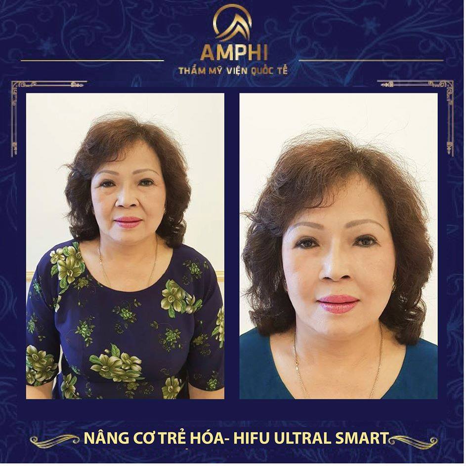 Nâng cơ trẻ hoá xoá nếp nhăn tại thẩm mỹ viện Amphi