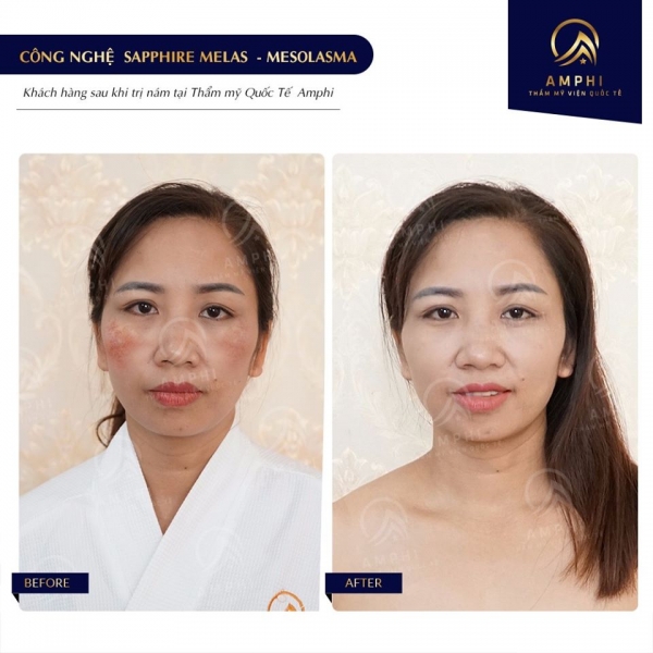 CHỊ THANH TRANG - TRỊ NÁM SHAPHIRE MELAS