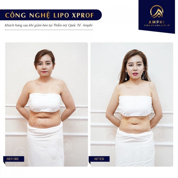 CHỊ NGUYỄN NGỌC MY - GIẢM BÉO LIPO XPROF