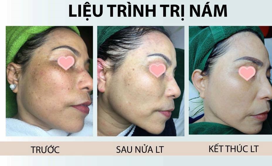 Điều trị nám Sapphire Melas tại Thẩm mỹ viện Amphi