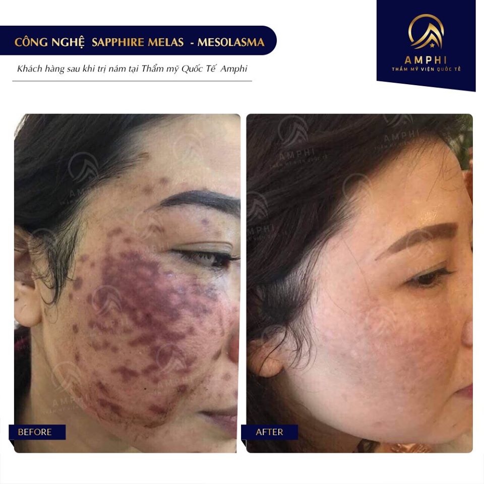 Điều trị nám Sapphire Melas tại Thẩm mỹ viện Amphi