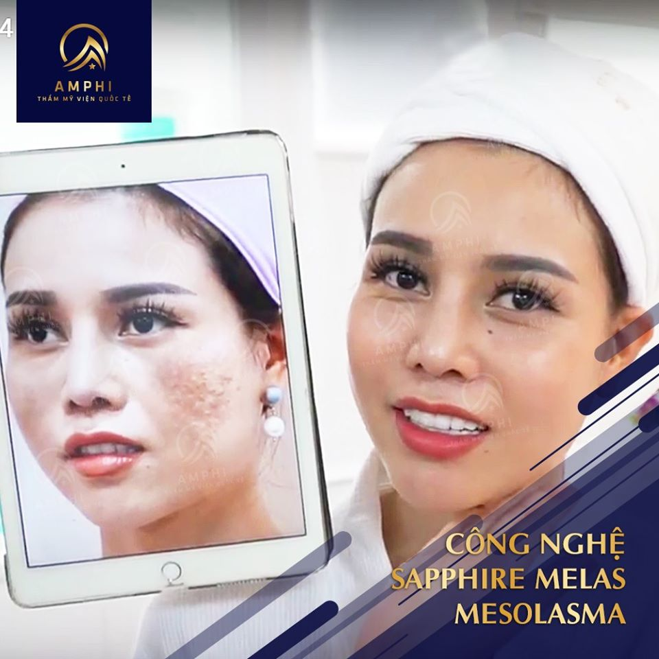 Điều trị nám Sapphire Melas tại Thẩm mỹ viện Amphi