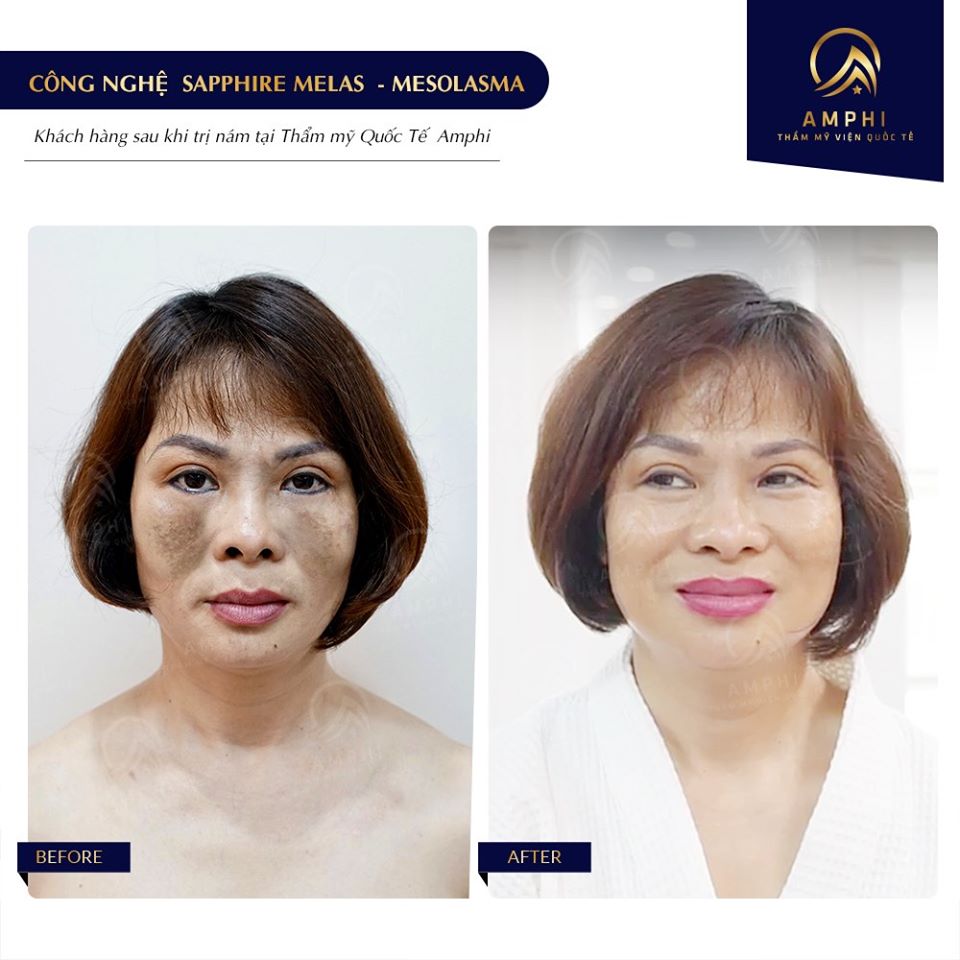 Điều trị nám Sapphire Melas tại Thẩm mỹ viện Amphi