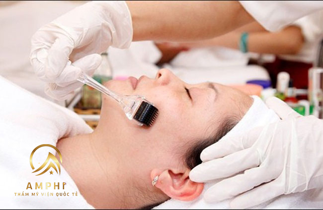 lăn kim trị nám có tốt không