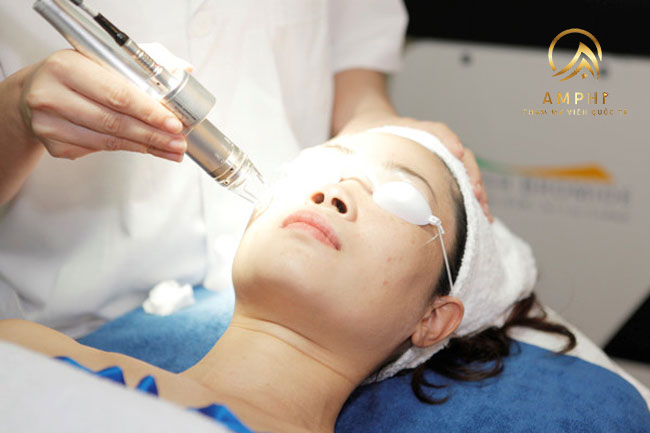 trị nám bằng laser