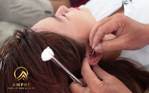 châm cứu giảm béo