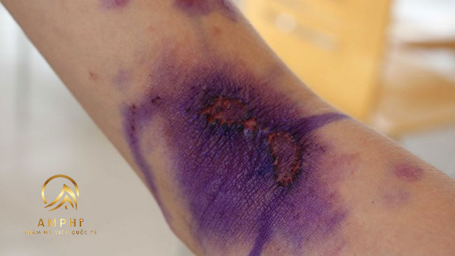 trị sẹo kiến ba khoang