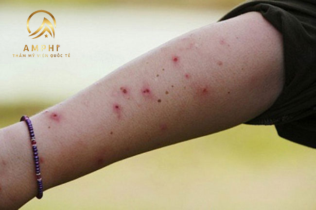 Tiết lộ mẹo trị sẹo muỗi đốt hiệu quả nhanh gọn Tiết lộ mẹo trị sẹo muỗi đốt hiệu quả nhanh gọn