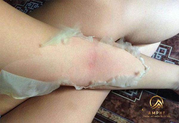 lột da tắm trắng