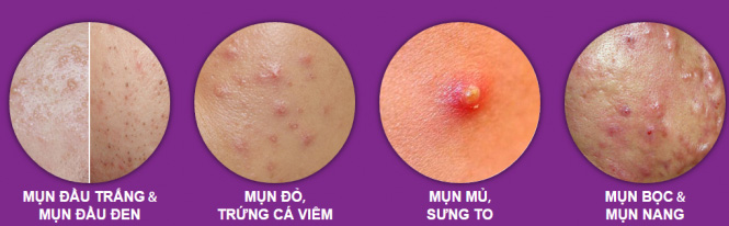 điều trị mụn tại Vela Spa