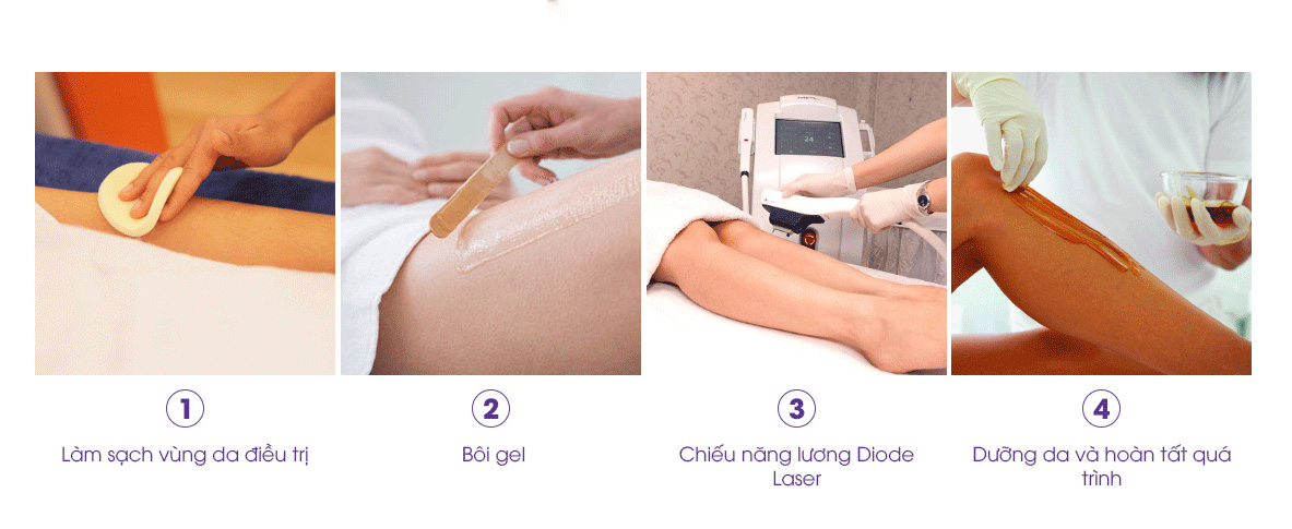 triệt lông tại vela spa